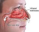 sinus infection